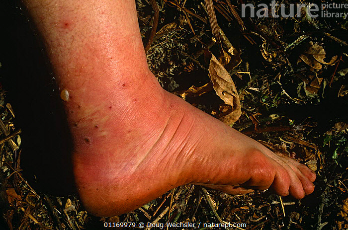 Stock photo of Foot swollen by edema due to allergic reaction to Leech bites,  Philippines. Available for sale on