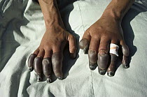 Andy Henderson's frostbitten fingers, photographed in Lhasa, one week after descending the North Face of Mt Everest, Tibet
