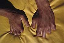 Andy Henderson's hands with fingers amputated, one year after suffering frostbite on the North Face of Mt Everest, Tibet