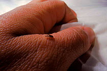 Bed bug on human skin