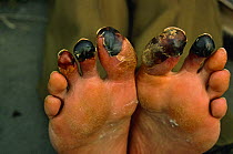 Frostbite damage to human toes