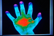 Thermograph of human hand