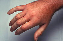 Hand swollen due to sting by Hornet {Vespa crabro} Dorset, UK