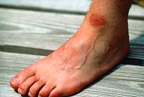 Infected tick bite on human leg.