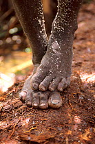 Close up of Korowai feet, Western Papuasia, Indonesia.  1999 / 2000. (West Papua).