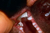 Ratel / Honey badger {Mellivora capensis} under sedation for reconstruction of broken canine teeth, Tsavo East NP, Kenya