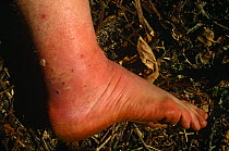 Foot swollen by edema due to allergic reaction to Leech bites, Philippines