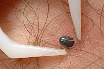 Using pincers to remove European sheep tick (Ixodes ricinus) from human skin, Germany