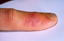 Robert Valentic's swollen finger one week after being bitten by the Northern death adder {Acanthophis praelongus} Australia