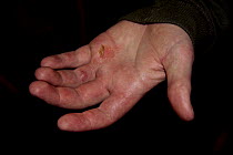 Blistered hand of Jim, Bristol mixed crew (winners) after the Avon River Cornish Pilot Gig Race, Bristol, March 21st 2009.