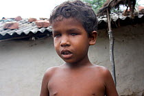 Blind boy, blindness caused by the endemic effect of pollution / poor diet, industrial slum, Bhopal, Madhya Pradesh, India, November 2008