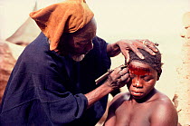 Dogon girl having cicatrization to her forehead, a sign of beauty in her culture. Mali, West Africa, 1981.