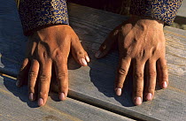 Hands of a buriat shaman, showing deformity of two thumbs on right hand, Olhkon Island, Baikal lake, Siberia, Russia, June 2000