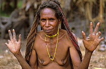 Portrait of Dani woman holding up her hands to show cut fingers, which signify mourning. Baliem valley, West Papua, former Irian-Jaya, Indonesia, August 2002 (West Papua).