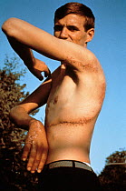 Rodney Fox shows his scar from attack by Great White Shark when he was badly bitten around the chest and arm in December 1963. South Australia. Model released.