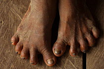 Huaorani Indian with splayed feet. Several of the Huaorani have these feet problems and there are some with 6 toes on each foot. Bameno Community, Yasuni National Park, Ecuador, May 2007.
