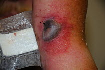 Bite from Cape Cobra snake (Naja nivea) on human limb,48 hours after the bite, showng blistering and swelling.  Western Cape, South Africa. Model released