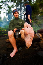 A hiker presenting his water-wrinkled foot to the camera. The West Coast Trail, Pacific Rim National Park, Vancouver Island, Canada, September 2010. Model released.
