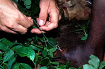 Removing Guinea worm (Dracunculus medinensis) from foot of african - parasitic nematode that causes guinea worm disease in people, Benin.