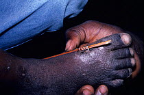 Removing Guinea worm (Dracunculus medinensis) from foot - parasitic nematode that causes guinea worm disease in people, Benin.