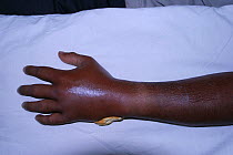 Swelling of hand due to a King Cobra (Ophiophagus hannah) bite, Western Ghats of southern India