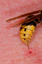 European Hornet (Vespo crabro) sting in human sting. **c, August.