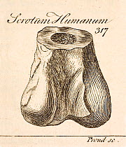 Copperplate print of human scrotum by Proud in R. Brookes 1763 'The Natural History of Waters, Earths, Stones, Fossils and Minerals etc.'; it seems to have been copied directly from Plot's 1677 plate...
