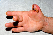 Hand with damaged thumb as result of Cobra (Naja naja naja) bite, India, November 2012