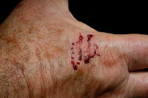 Green rat snake (Boiga cyanea) bite marks on human hand. Venomous species.