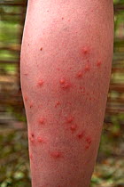 Human leg covered in Mosquito (Culicidae) bites.