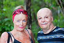 Burns victims who work for the Peter Hughes Burn Foundation in Australia providing counselling and support for the victims of the bush fires. Australia, February 2010.