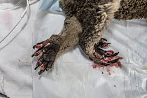 Burnt feet of anaesthetised  female Koala (Phascolarctos cinereus) as she is treated, at a mobile wildlife triage centre at Bairnsdale, which was set up to treat animals as a result of the bushfires t...
