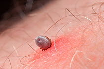 Sheep / Deer Tick (Ixodes ricinus) feeding on human host causing localised swelling. Scotland, UK. June. This species can be a vector for both Lyme disease and tick-borne encephalitis.