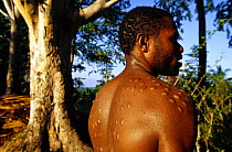 Crocodile Man, scarification from the wagan initiation ceremony into manhood. The skin on the chest, back and buttocks of the initiate is cut with a bamboo sliver. The scars, when healed, represent th...